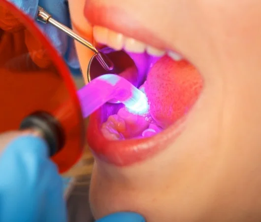 Cosmetic Dental Bonding-img