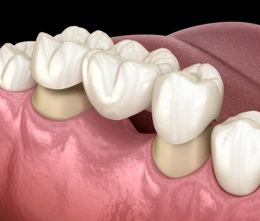 Dental Bridges-img