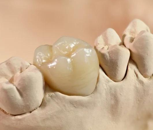 Dental Crowns-img