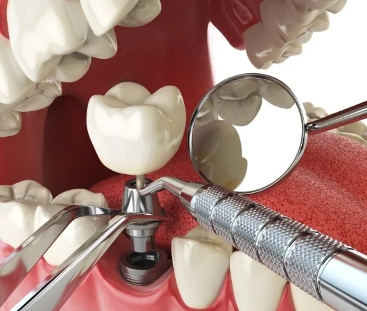 Dental Implants - A Multiple Step Process-img