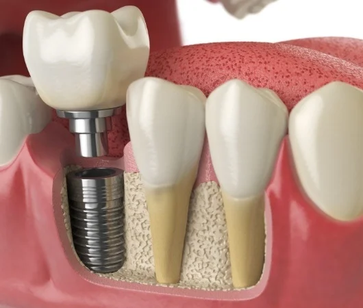 Dental Implants-img