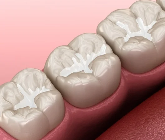 Dental Sealants-img
