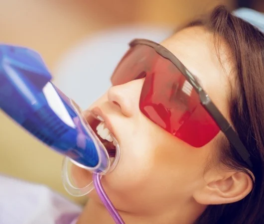 Fluoride Varnish-img