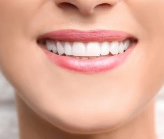Full Mouth Restoration & Rehabilitation-img