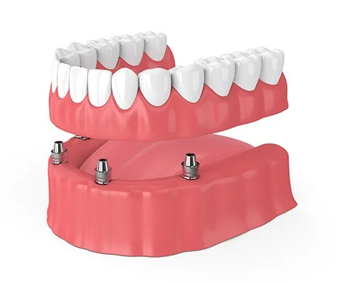 Implant Dentures-img