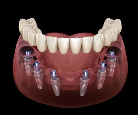 Missing All of Your Teeth-img
