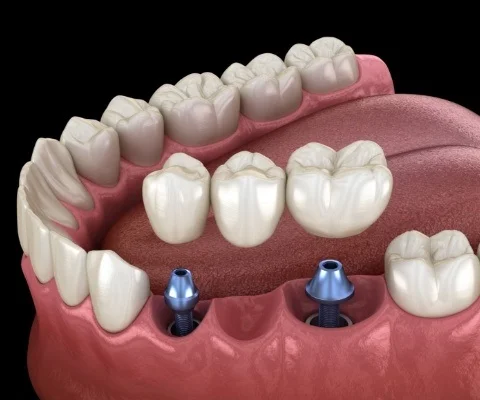 Missing Multiple Teeth-img