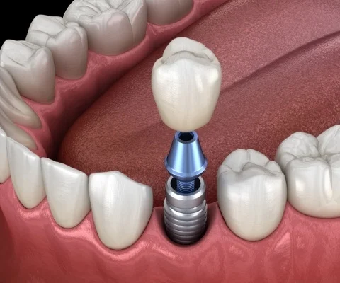 Missing One Tooth-img