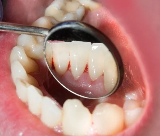 Oral Cancer Screening-img