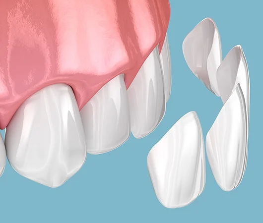 The Process of Getting Veneers-img