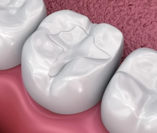 Tooth-Colored Fillings-img
