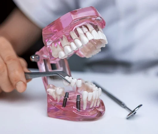 Types of Dental Bridges-img