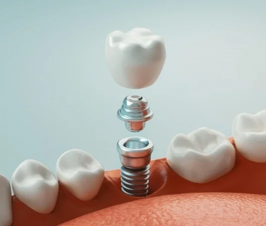 What Are Dental Implants-img