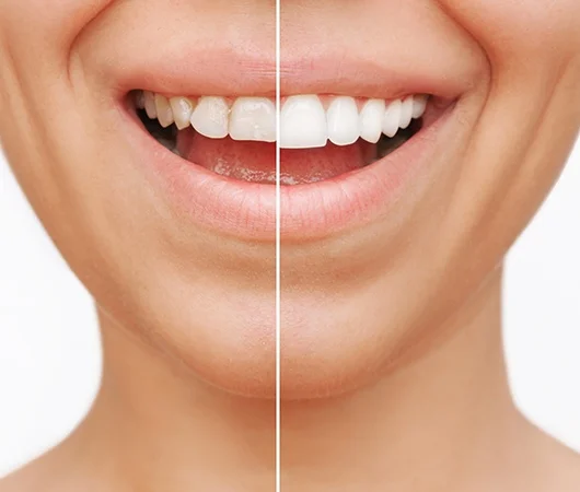 What Are Dental Veneers-img