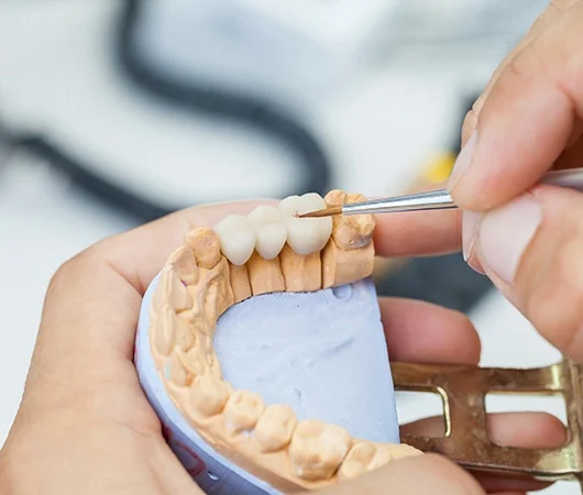 What Is a Dental Bridge-img