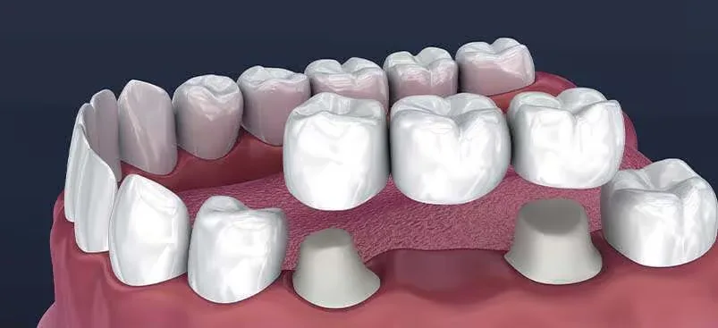 dental-bridges