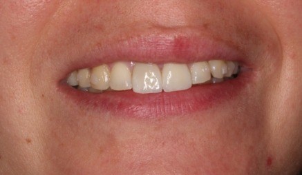 Close up of improved teeth after cosmetic dentistry